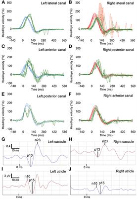 Acute Unilateral Peripheral Vestibulopathy After COVID-19 Vaccination: Initial Experience in a Tertiary Neurotology Center